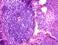 T lymphocyte attacking pancreatic cells