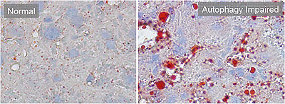 The inability to activate autophagy (right) results in massive