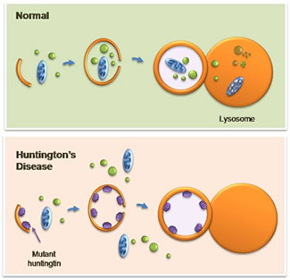 In a normal cell (above), a membranous structure known as an autophagosome collects cellular debris and delivers it to an enzyme-filled bag called a lysosome for digestion. But in Huntington's disease (below), defective huntingtin proteins (in purple) stick to the inner layer of the autophagosome, preventing it from collecting debris. The autophagosome arrives empty at the lysosome, allowing debris to accumulate to toxic levels inside the cell.