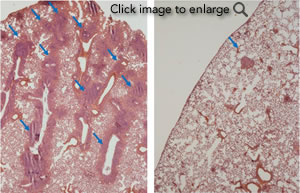 Images of metastasis (tumor spread) in lungs of two mice: untreated tumor (left) and a tumor in which autophagy has been blocked (right). Metastatic areas are dark pink (arrows). A tumor’s ability to metastasize decreases dramatically when autophagy is halted.