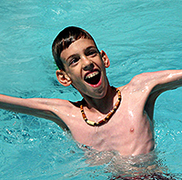 Billy, a boy with Marfan's syndrome