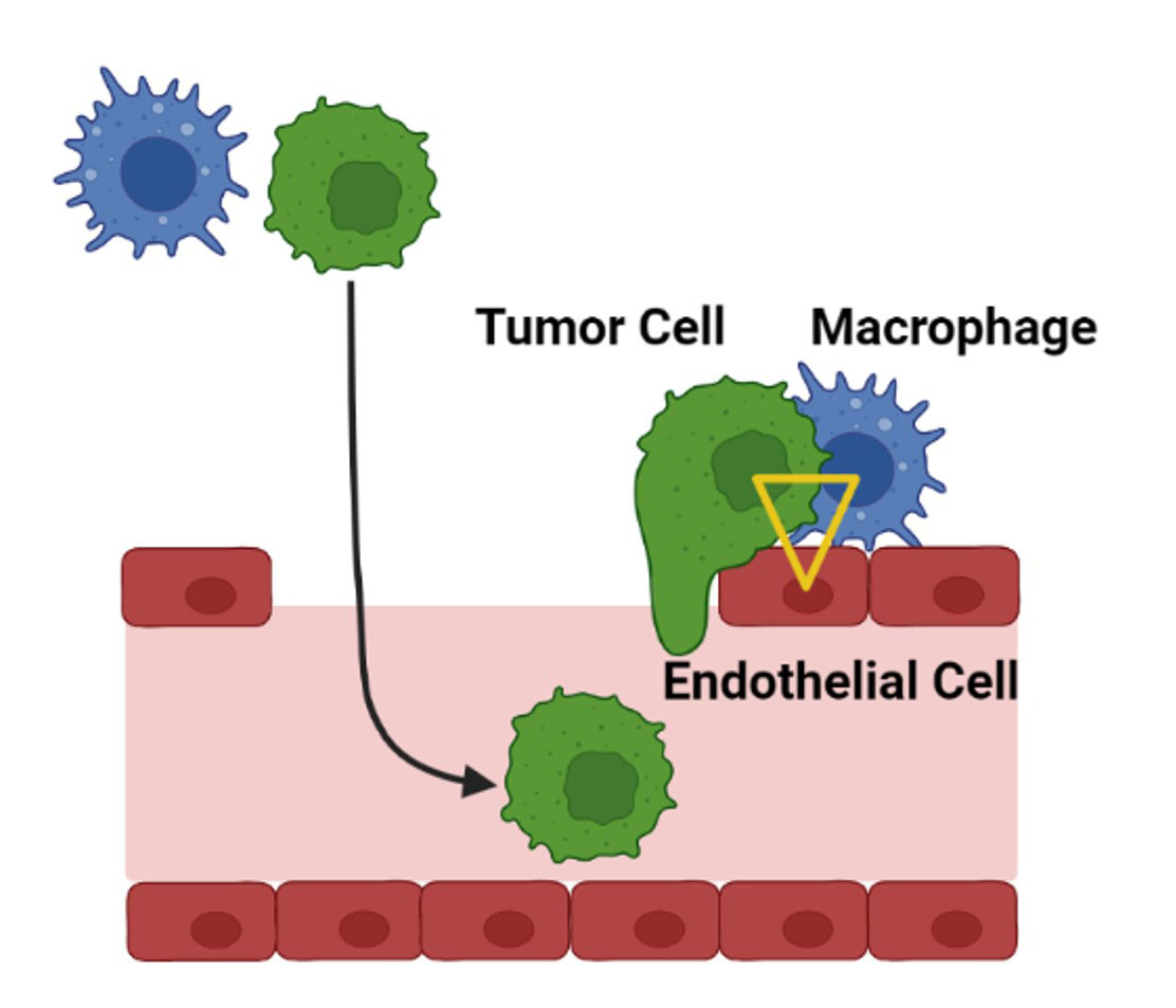 A tumor microenvironment of metastasis (TMEM) doorway forms when three specific cells are in direct and stable contact (yellow triangle): an endothelial cell (a type of cell that lines blood vessels), a macrophage (a type of immune cell), and a tumor cell. TMEM doorways act as “portals” that enable tumor cells to enter the blood stream and travel to other parts of the body. Tumors with high density of TMEM doorways in a tissue sample (i.e., tumors with a high TMEM “score”) are more likely to metastasize compared with tumors with lower TMEM scores.