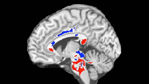 This image of a concussion patient's brain shows low FA areas (red) probably signifying injured white matter, plus high FA areas (blue) perhaps indicating more efficient white-matter connections  compensating for concussion damage. A large amount of high FA predicts recovery from concussion. Researchers, led by Michael Lipton, M.D., Ph.D., at Albert Einstein College of Medicine and Montefiore Health System, using an advanced imaging technique, have been able to predict which patients who’d recently suffered concussions were likely to fully recover. Photo credit: Photo reproduced from Strauss SB, Kim N, Branch CA. Bidirectional Changes in Anisotropy Are Associated with Outcomes in Mild Traumatic Brain Injury. AJNR Am J Neuroradiol 2016 Jun 9. [Epub ahead of print]
