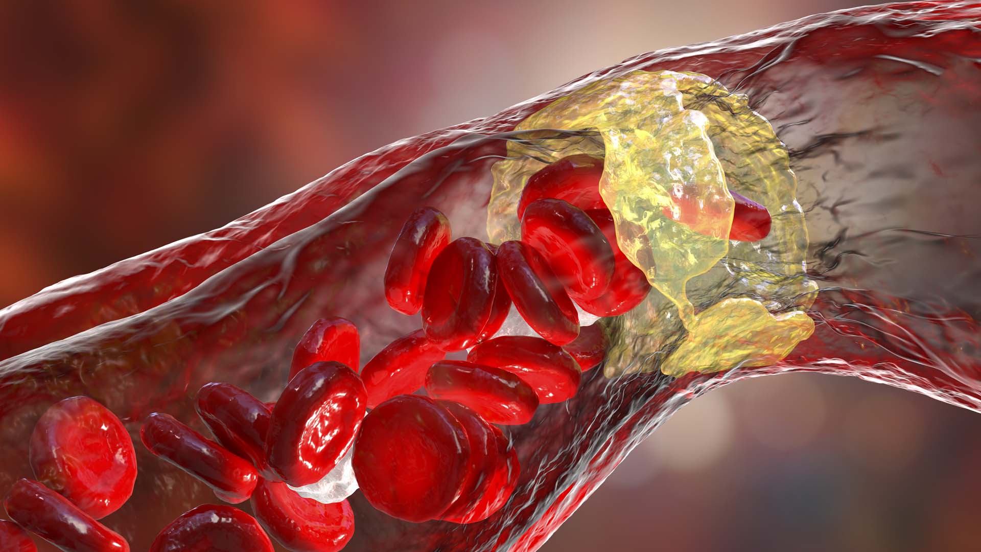 Einstein Researchers Find New Strategy for Preventing Clogged Arteries