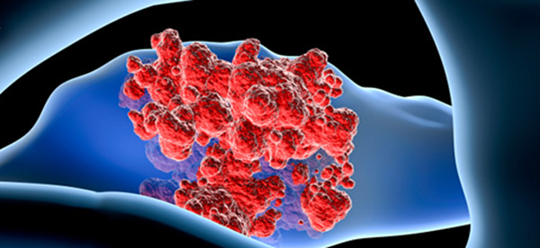 Radioactive Bacteria Targets Metastatic Pancreatic Cancer