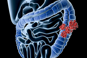 Three Major NIH Grants for Defeating Colorectal Cancer