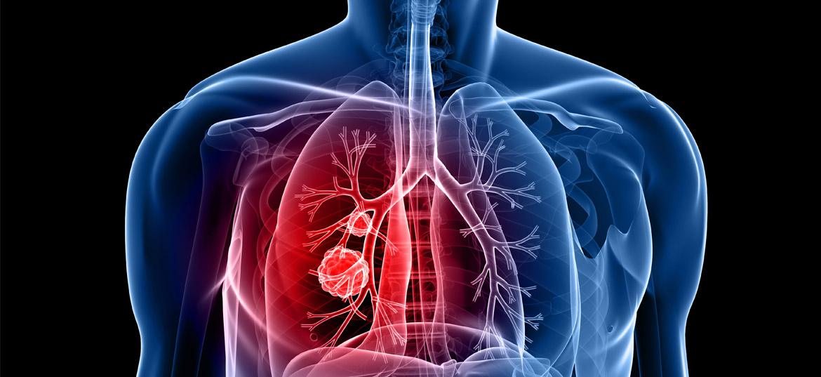 Breakthrough Treatment Helps Prolong Life for People with Metastatic Lung Cancer