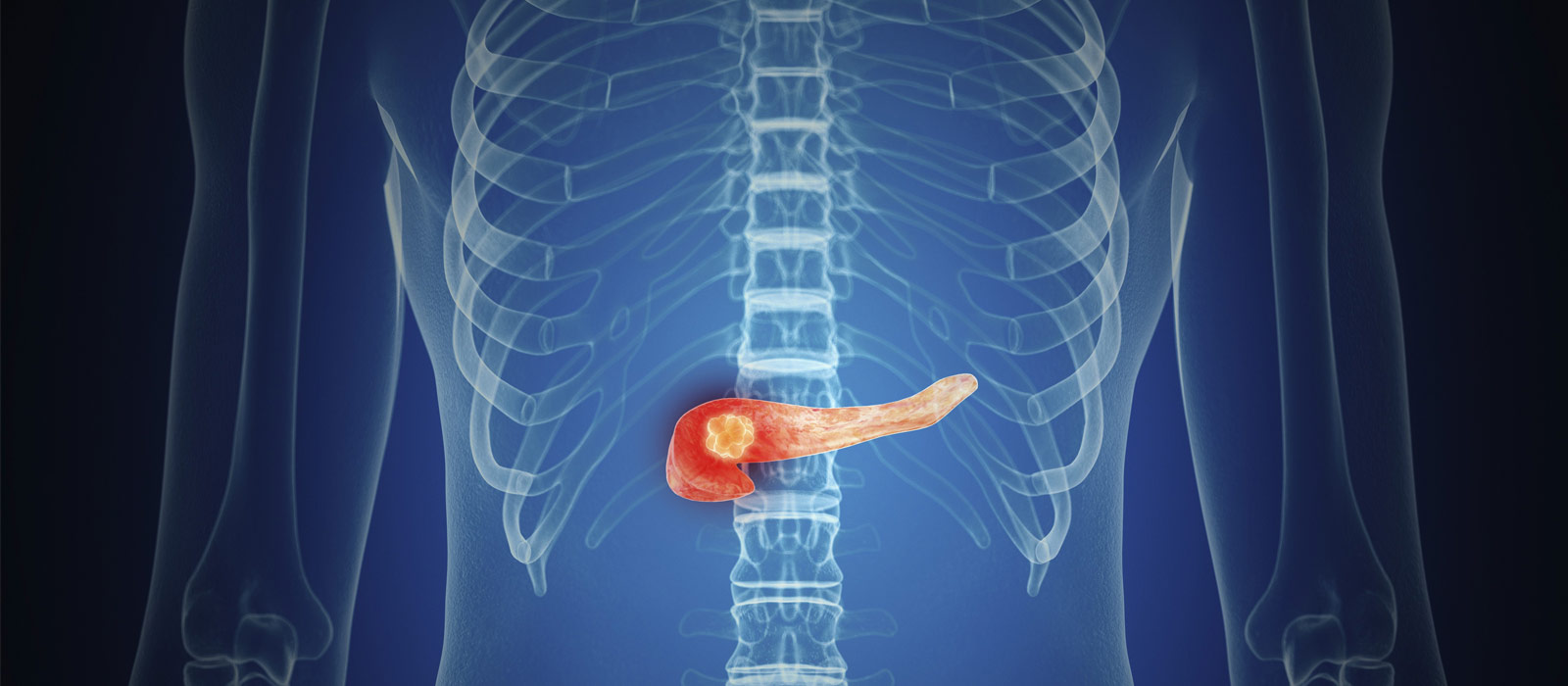New Clue to Pancreatic Cancer Tumor Formation