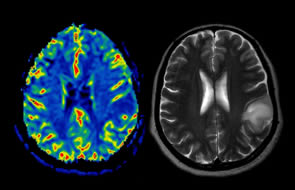 Detecting Combat Brain Injury with DTI