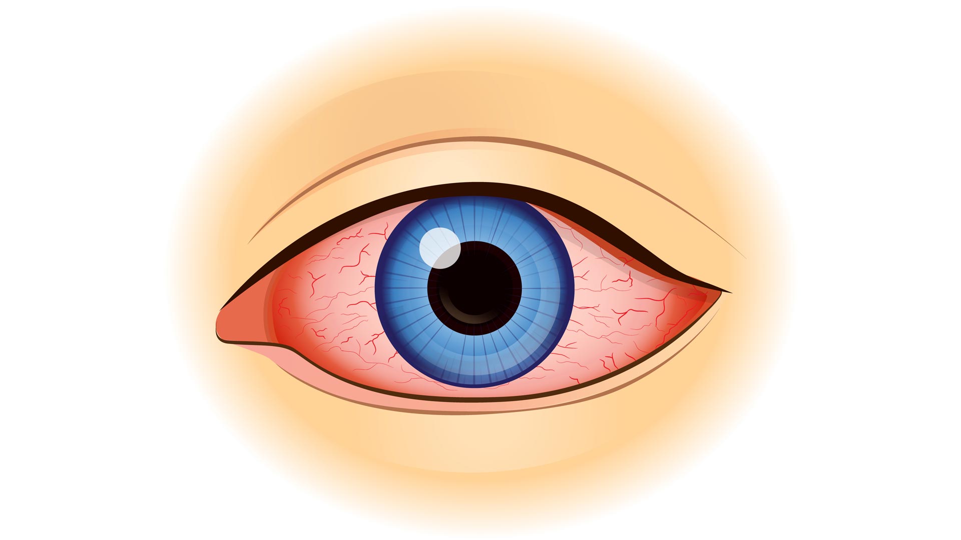 New Therapy for Corneal Burns