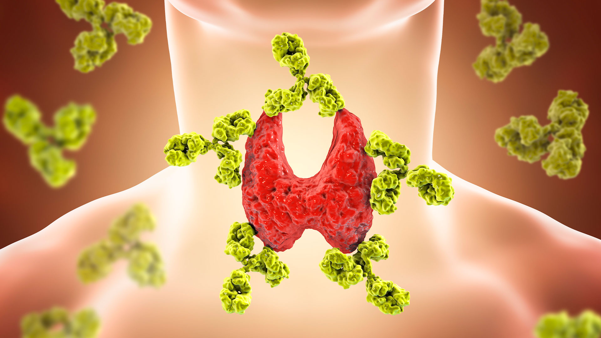 Finding the Causes of Autoimmune Thyroid Diseases