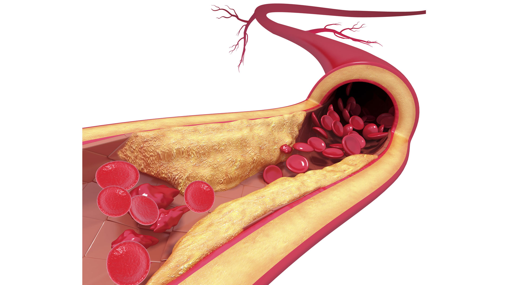 Mortality Predictors Associated with Extreme Levels of 'Bad' Cholesterol