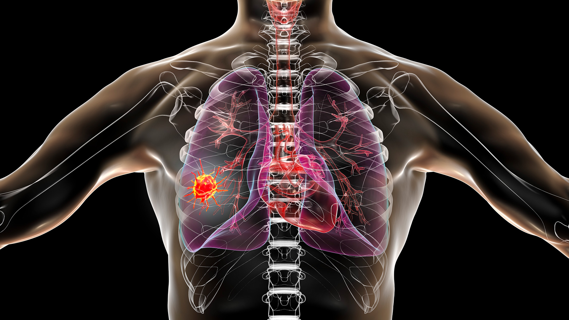 Breath Test for Detecting Lung Cancer