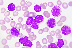 New Mutations Found in Rare Lymphoma/Leukemias