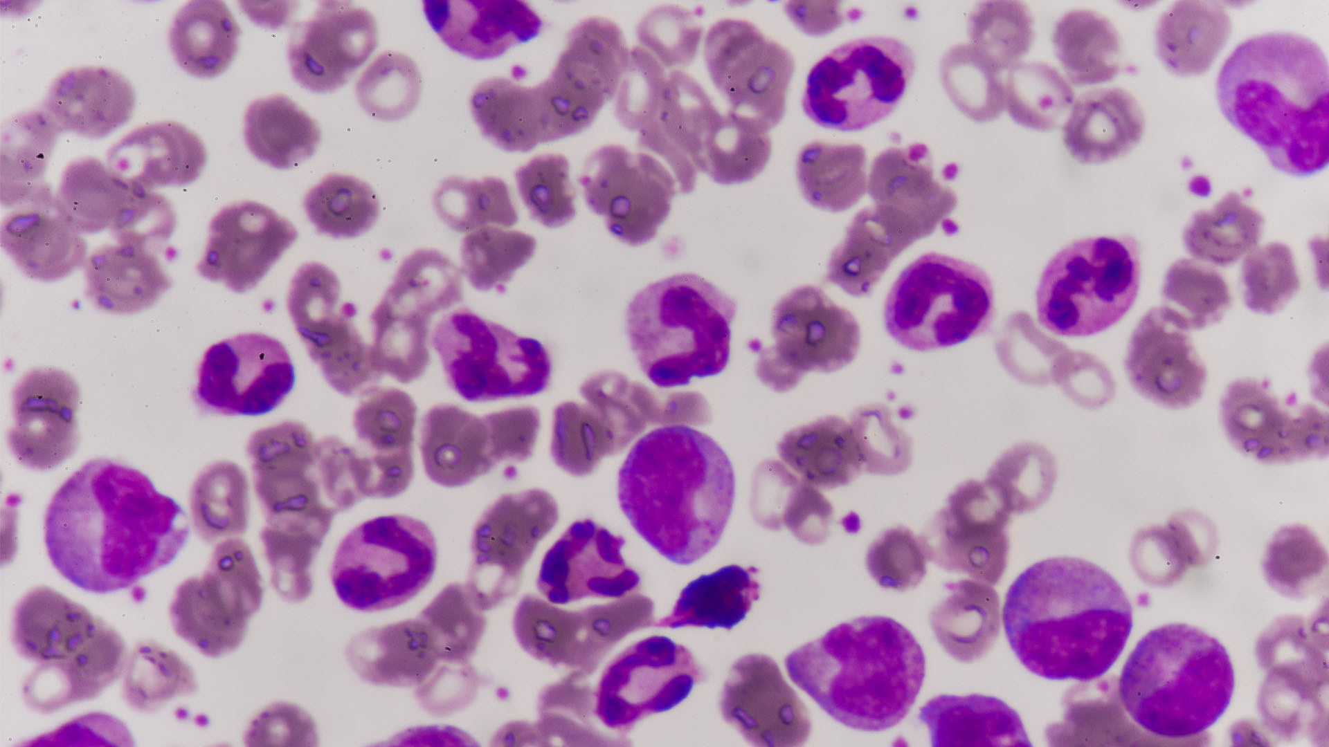 Pursuing ‘Synthetic-Lethal’ Therapy for Lymphoma